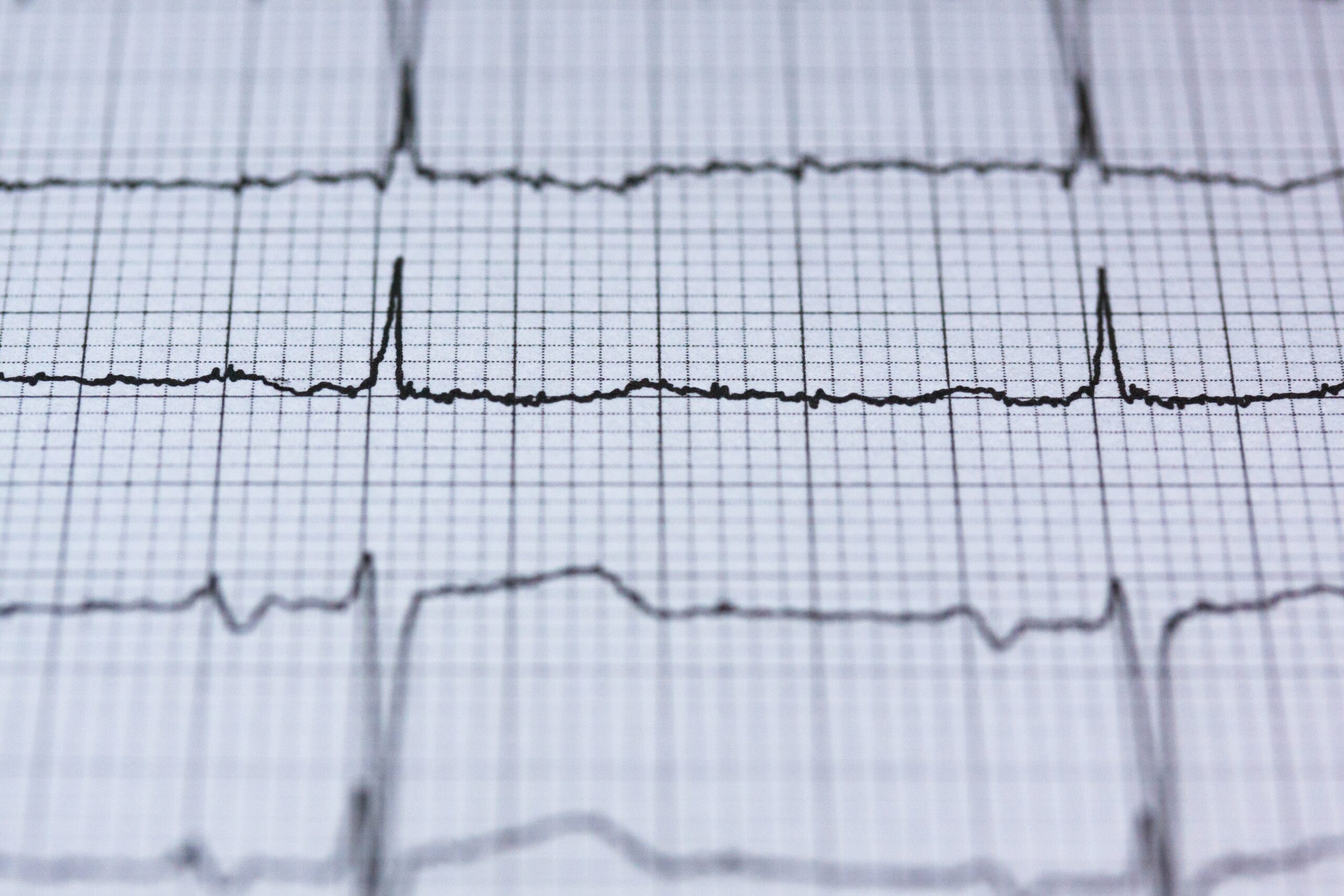 EKG – rozmieszczenie elektrod i jego znaczenie